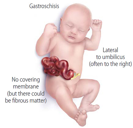 baby-gastroschisis